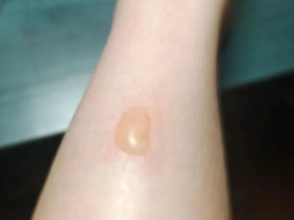 女子睡醒，发现腿变成这样！医生：正是高发期