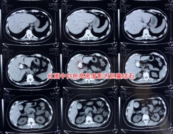 女子常年熬夜晚睡饮食不规律，胆囊里竟养出3公分巨石