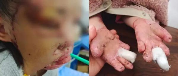 太痛心了！8岁女童意外烧伤毁容手指截肢……