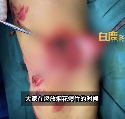 揪心！9岁男孩瓶内放炮，被扎30多块玻璃渣