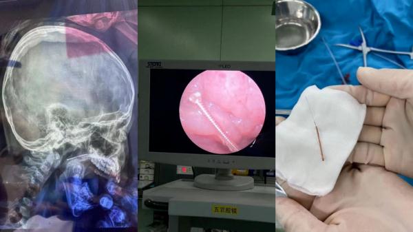 “医生，医生……快来看看，针灸针进孩子鼻孔里了！”