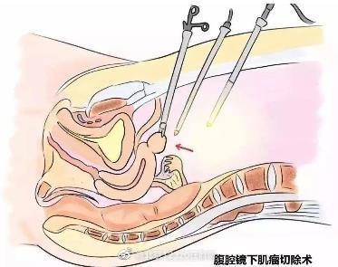 子宫肌瘤的手术方式有哪些？