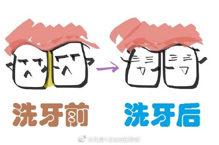 为什么洗牙后牙缝变明显了？该怎么办？