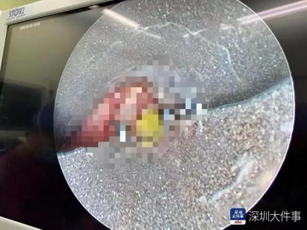 警惕!1岁男童险丧命,只因吃了它,很多人家里都有 警惕!1岁男童险丧命,只因吃了它,很多人家里都有