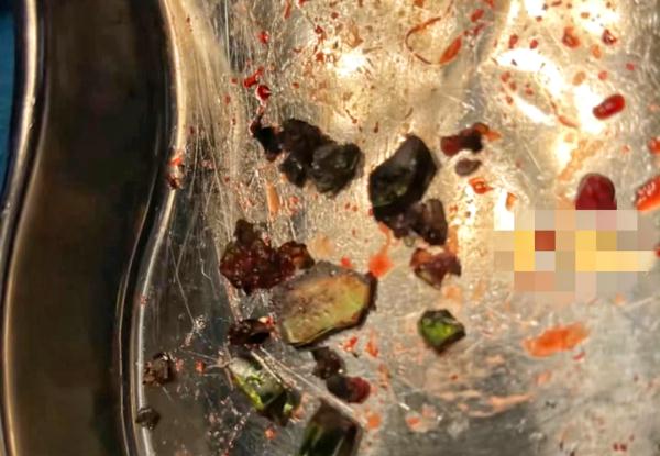 可怕！男孩一个动作，身上扎入30多块玻璃渣