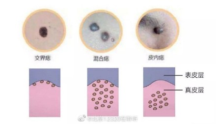 色素痣常见的类型有哪些？