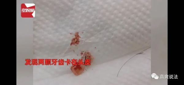 太离谱！“两颗牙齿在我脑袋里住了一个星期”？！