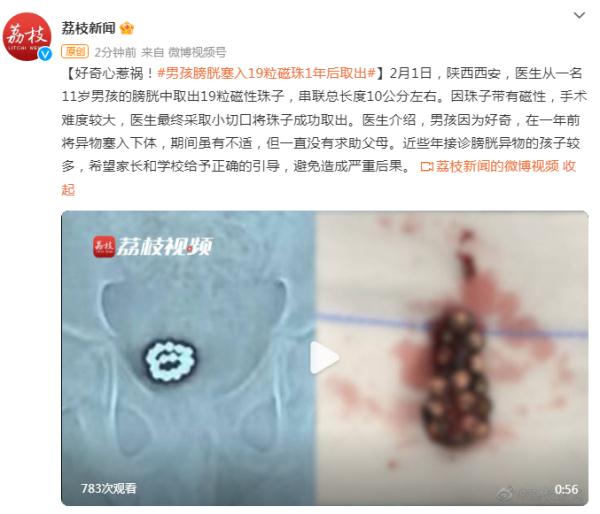 好奇心惹祸！男孩膀胱塞入19粒磁珠，1年后取出