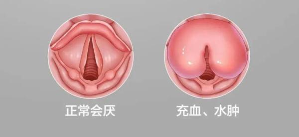 突然喉咙痛,男子呼吸困难险送命!这种嗓子疼千万别忽视! 突然喉咙痛,男子呼吸困难险送命!这种嗓子疼千万别忽视!