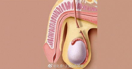 男性结扎不影响性功能