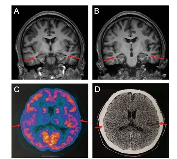 19岁男孩患阿尔茨海默症？医生分析️→