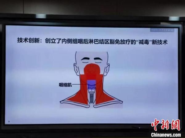 中国团队创新“减毒”技术 99%鼻咽癌患者将从中受益