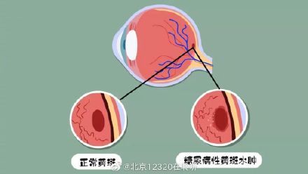 如何预防糖尿病黄斑水肿? 如何预防糖尿病黄斑水肿?