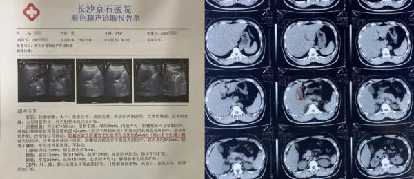 肉食爱好者天天吃肉不停歇，胆囊养出近20颗“小金豆”
