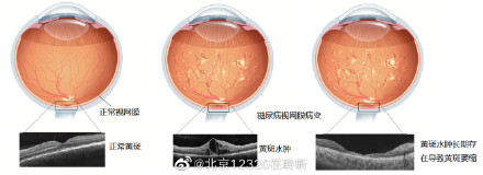 如何治疗糖尿病黄斑水肿?