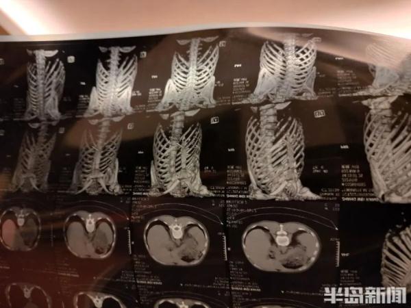 这得多大仇!小区物业经理用膝盖顶断业主三根肋骨 这得多大仇!小区物业经理用膝盖顶断业主三根肋骨