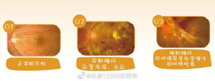 糖尿病视网膜病变如何分期? 糖尿病视网膜病变如何分期?