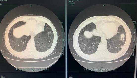 大爷常去西湖边喂鸽子，肺上竟多了几个“白洞”！