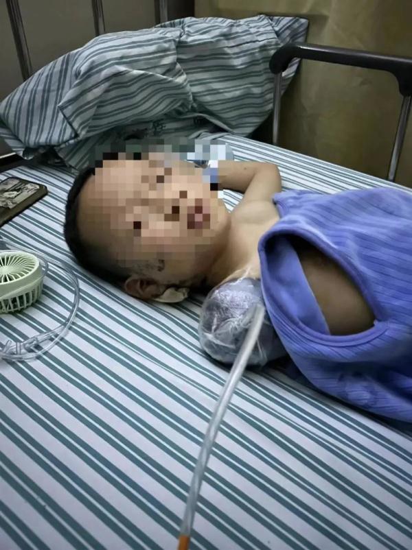 鞭炮致男童截肢!最新进展:涉事邻居已被刑拘 鞭炮致男童截肢!最新进展:涉事邻居已被刑拘