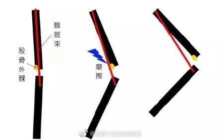 为什么会发生髂胫束摩擦综合征？