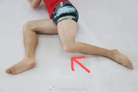 髂胫束摩擦综合征的检查方法