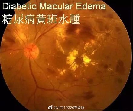 什么人群需要警惕糖尿病黄斑水肿的发生？