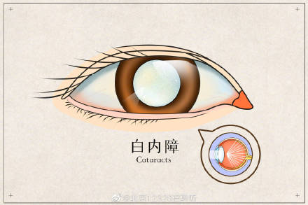 白内障手术后注意事项