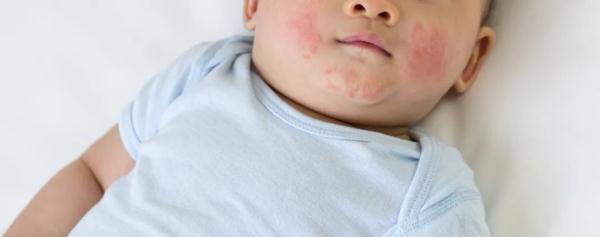 身上有小红点,别不当回事!可能是肾损伤! 身上有小红点,别不当回事!可能是肾损伤!