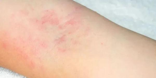 身上有小红点,别不当回事!可能是肾损伤! 身上有小红点,别不当回事!可能是肾损伤!