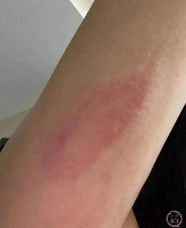 中国游客泰国普吉体验丛林飞跃被马蜂袭击受伤 遭遇维权难 中国游客泰国普吉体验丛林飞跃被马蜂袭击受伤 遭遇维权难