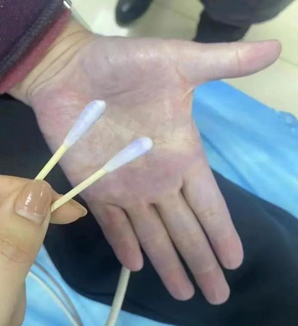 沈阳一大爷双手青紫，紧急送往医院！病因竟是……