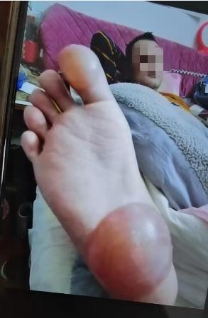 怪!一觉醒来脚底“长”了个大包,原来都是它惹的祸 怪!一觉醒来脚底“长”了个大包,原来都是它惹的祸