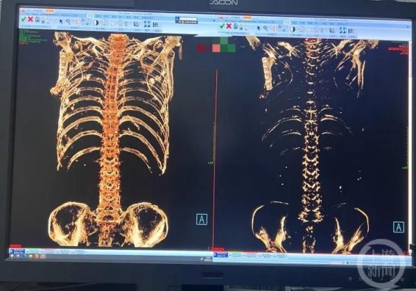男子严重缺钙，CT检查居然是“透明人”！医生提醒
