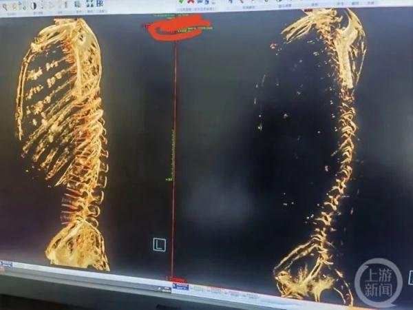 男子严重缺钙，CT检查居然是“透明人”！医生提醒