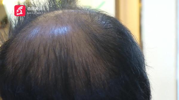 为治脱发去涂药，头发却越掉越多？