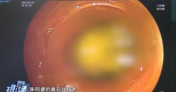 74岁阿婆腹痛难忍，医生“开处方”让她喝3天可乐