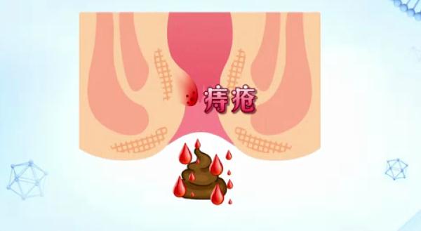 大便出血…是痔疮还是癌症？简单几点，教你辨别！