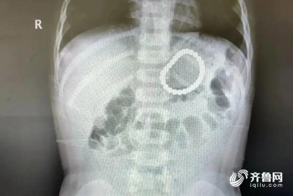 2岁幼童误吞28颗磁力珠！险些造成胃穿孔……医生提醒→
