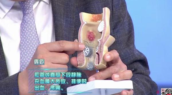 大便出血…是痔疮还是癌症？简单几点，教你辨别！