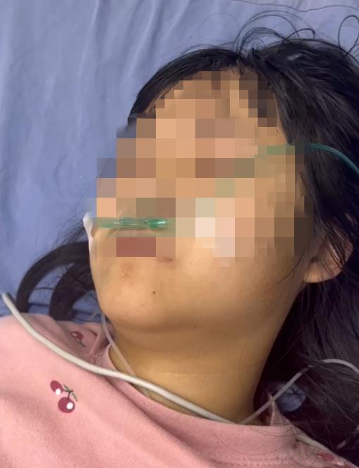 惊!厦门13岁女孩“阳”后猛吃喝,陷入重度昏迷!死亡率超80%...... 惊!厦门13岁女孩“阳”后猛吃喝,陷入重度昏迷!死亡率超80%......