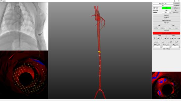 我国自主研发新一代微创血管介入手术机器人 已成功完成多例临床试验 我国自主研发新一代微创血管介入手术机器人 已成功完成多例临床试验
