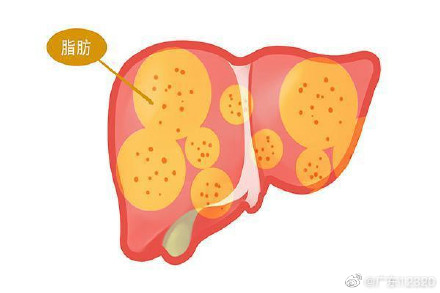 脂肪肝可以不治自愈吗？
