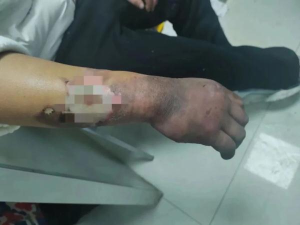 “这伤口不对劲！”他一句话救回一条命