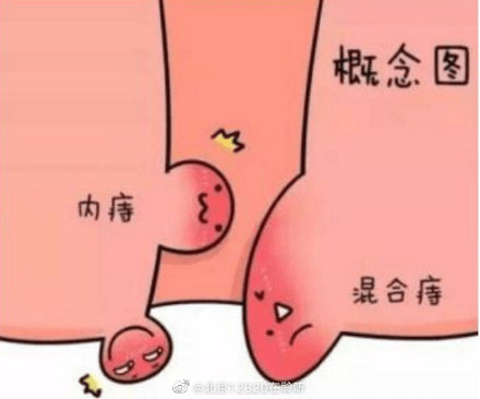 为什么肛周疾病中，痔疮多发？