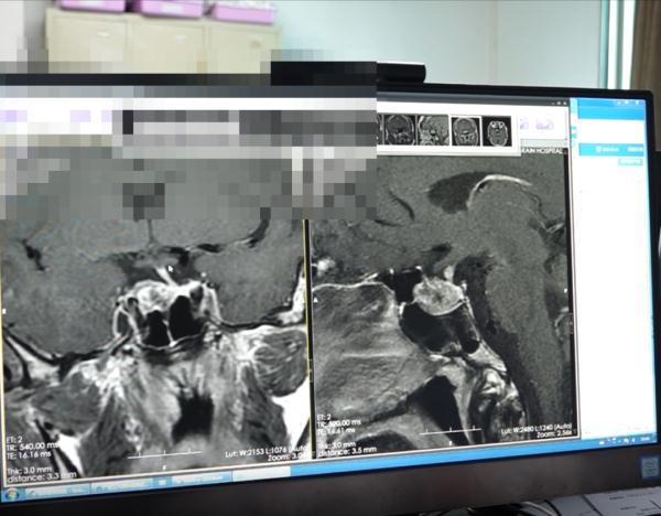 昔日“校草”变丑！原以为是中年发福，没想到是得了这个病