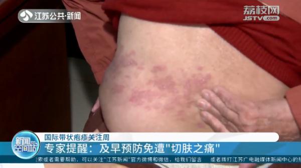 什么是带状疱疹？如何预防？一文了解→