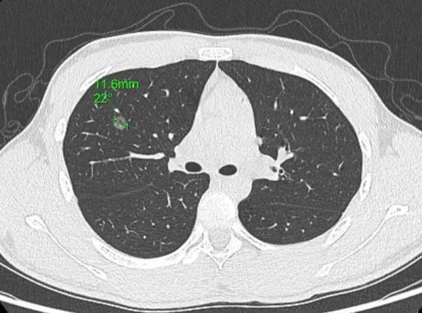 一家4口接连确诊癌症！