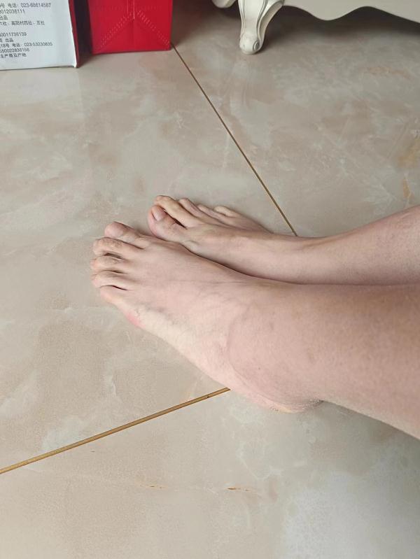 “我们也没想到，43码的脚，竟然是种病”