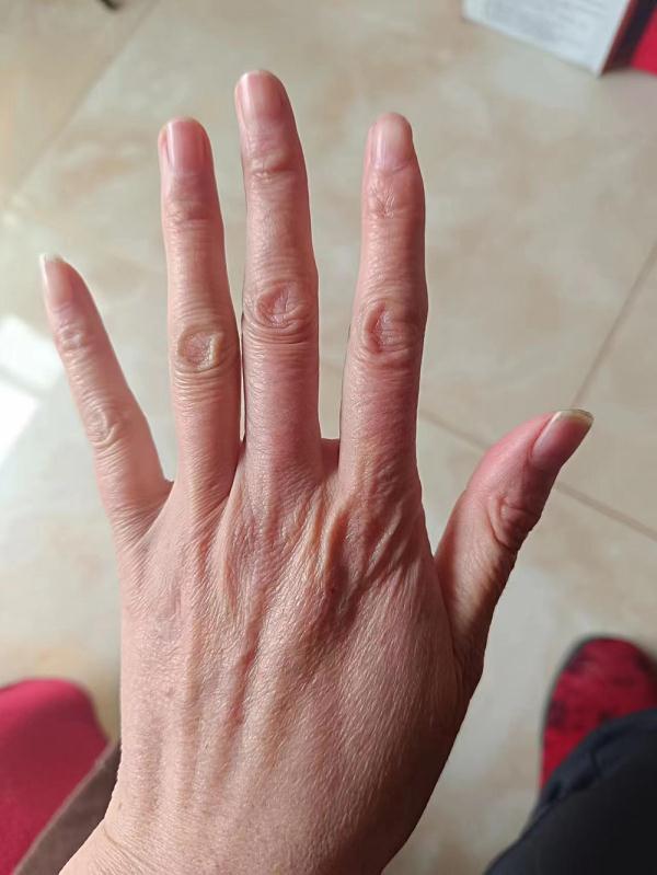 “我们也没想到，43码的脚，竟然是种病”