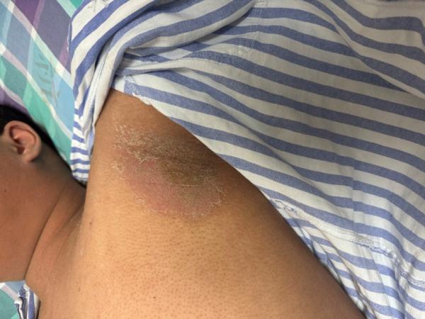 杭州一男生全身皮肤溃烂,只因吃了几口这种水果!眼下正大量上市 杭州一男生全身皮肤溃烂,只因吃了几口这种水果!眼下正大量上市